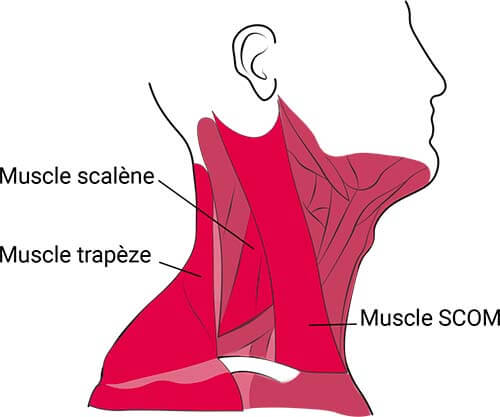 Muscles torticolis et douleur cervicale