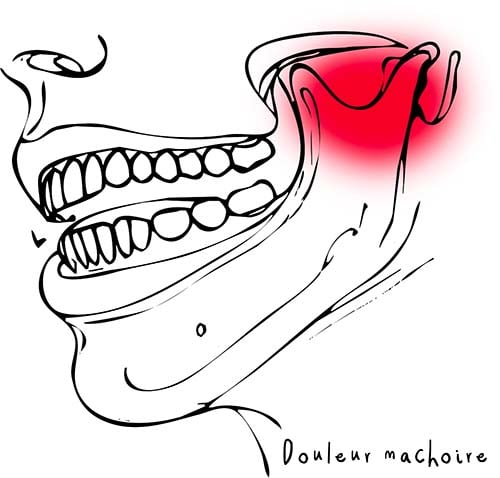 Douleur mâchoire