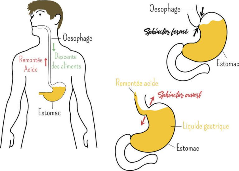 Reflux GastroOesophagien Ostéopathe à Paris 13 et Paris 15