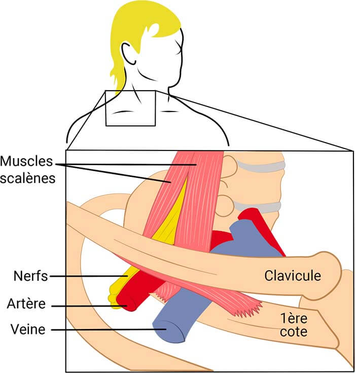 Syndrome du défilé thoraco brachial