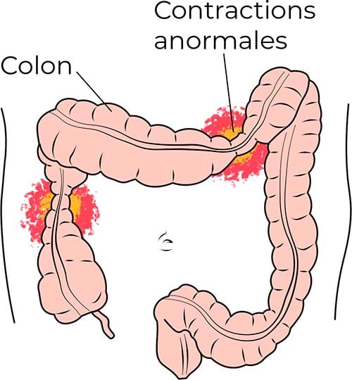 Syndrome colon irritable