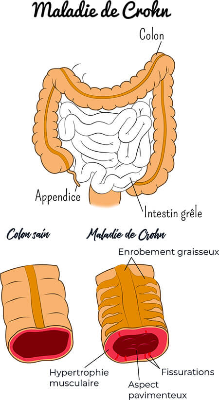 Maladie de Crohn illustration