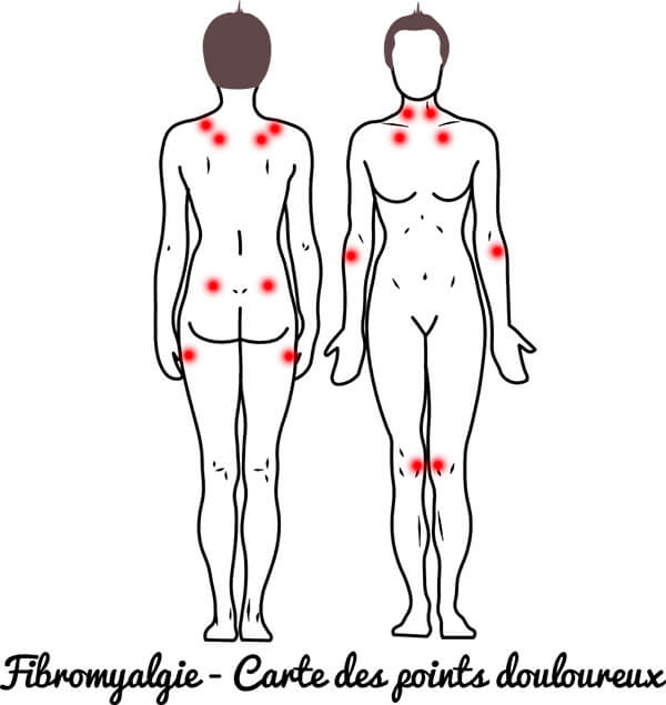 Fibromyalgie - carte des points douloureux