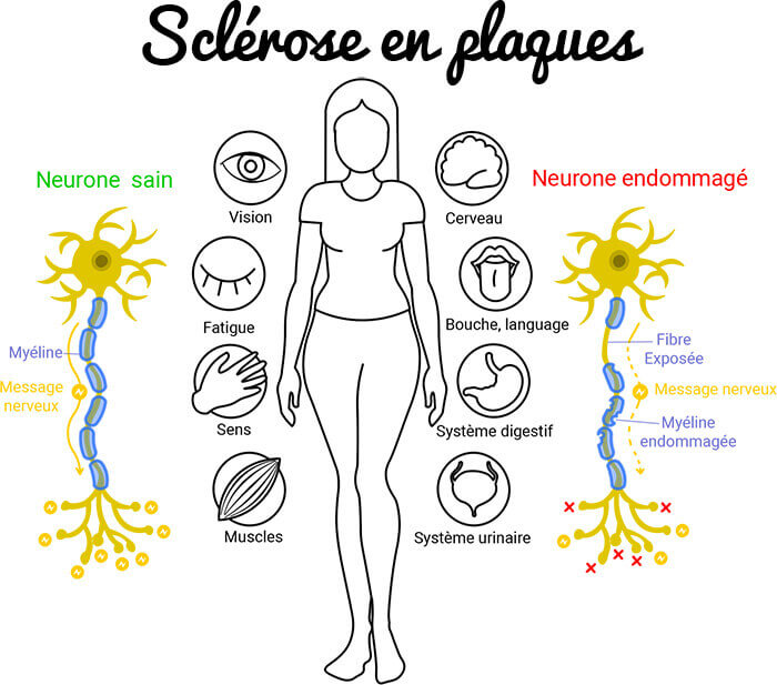Sclérose en plaques
