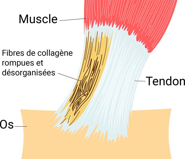 8 choses à savoir sur la tendinite - Ostéopathe à Paris 13 et Paris 15