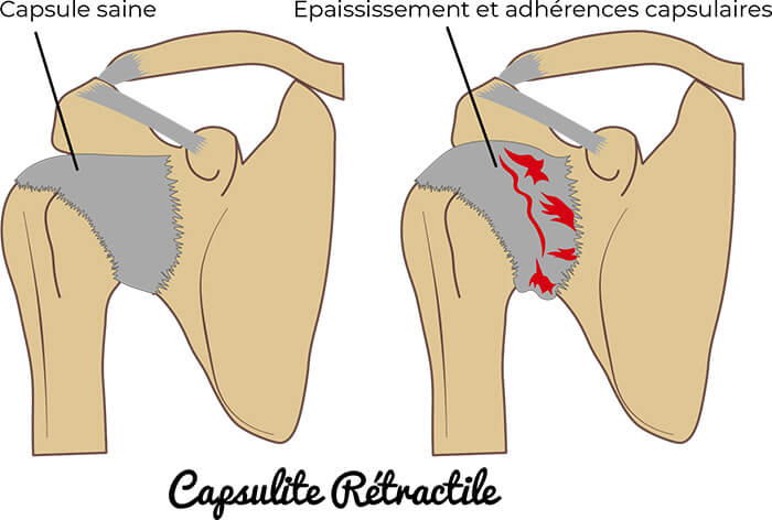 8 choses à savoir sur la capsulite rétractile de l'épaule - Anatomie