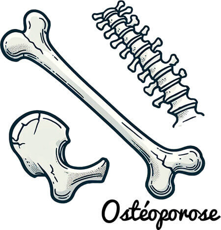 8 choses a savoir sur l'osteoporose