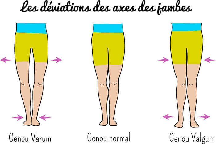 Déviation jambes - gonarthrose