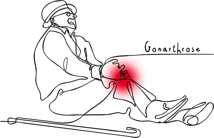 Gonarthrose