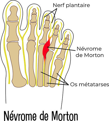 Anatomie Névrome de morton