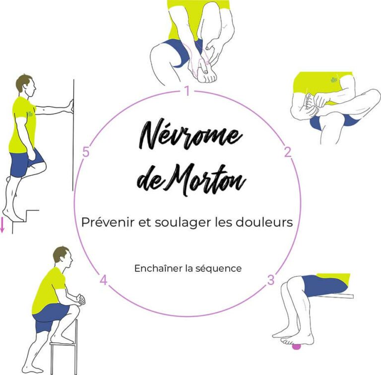 Névrome de Morton Des exercices efficaces d