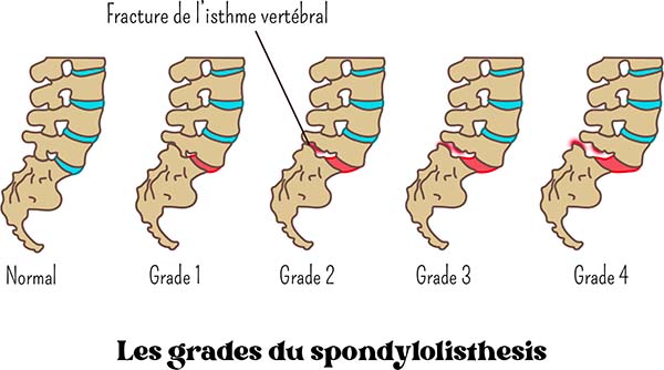 Grades spondylo