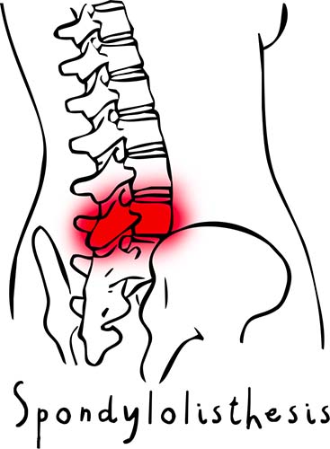 spondylolisthesis lombaire anatomie