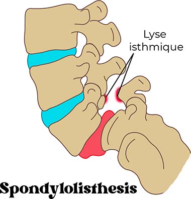 spondylolisthesis lyse isthmique