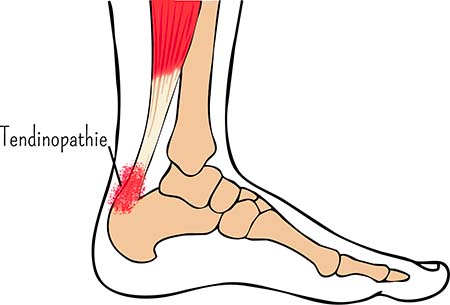 Tendinite du tendon d'Achille