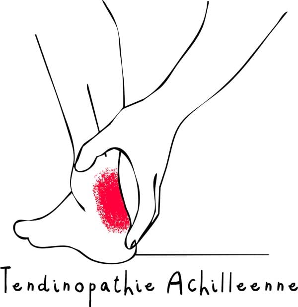 Tendinopathie Achilléenne